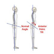 AnteriorPelvicTilt