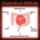 ClostridiumDifficile