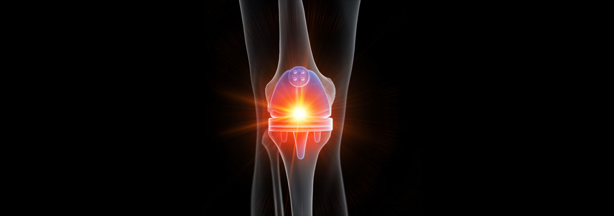 KneeReplacement