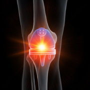 KneeReplacement