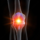 KneeReplacement