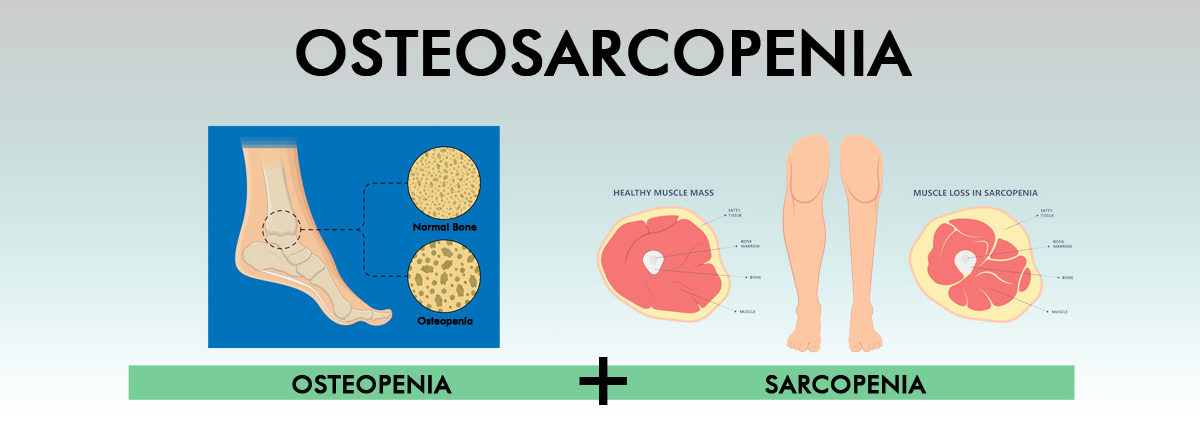 Osteosarcopenia