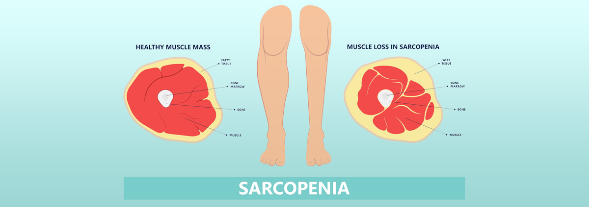 Sarcopenia
