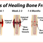 HealingBone