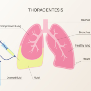 Thoracentesis