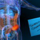 Colon-Cancer